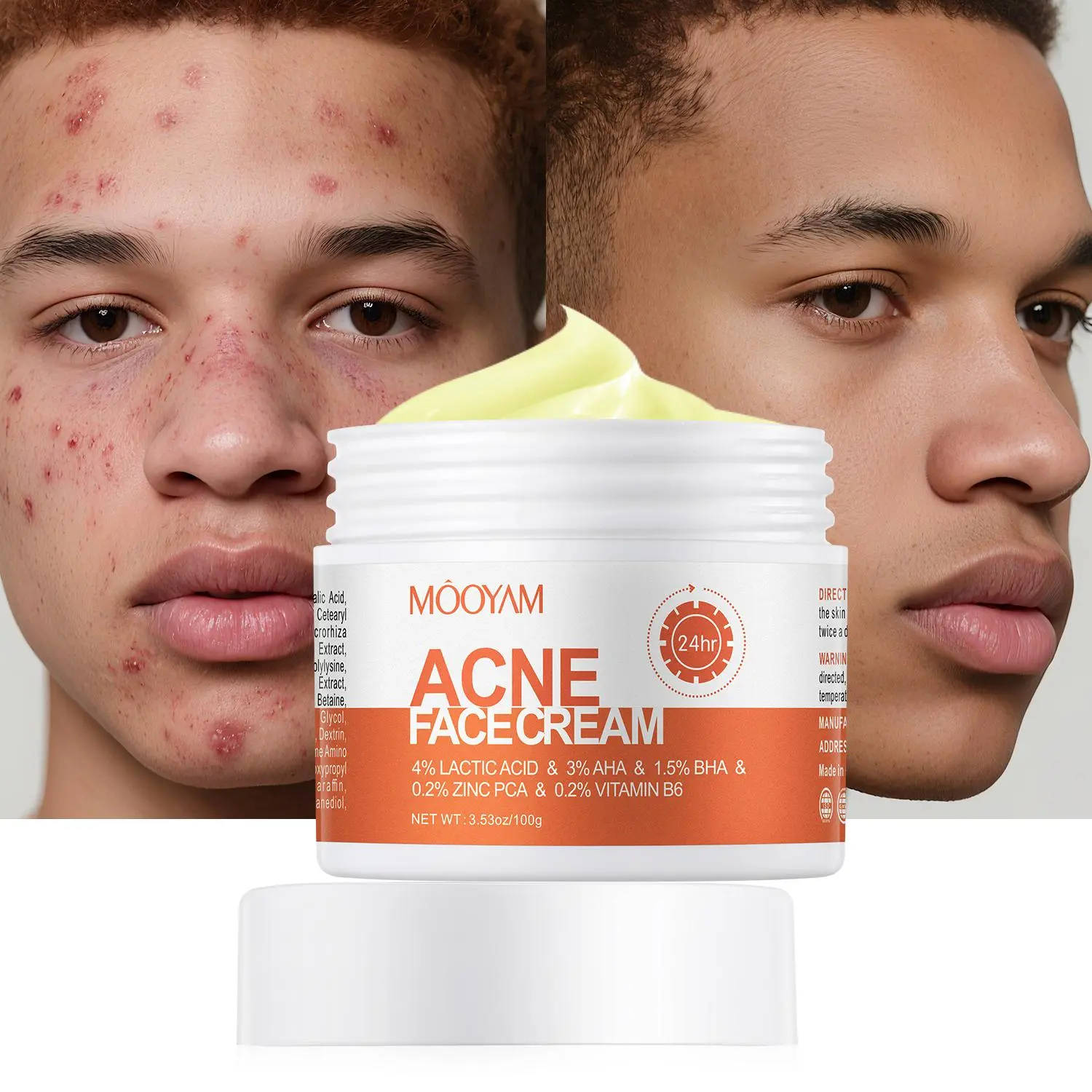 MOOYAM Acne Cream with Centella & Snail Extract, Salicylic Acid, AHA - Pore Unclogging Redness Relief, Dark Spot Fighter Acne Treatment Skincare Gel, Dark Spot Fighter Acne Treatments
