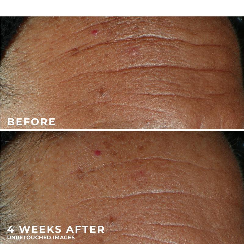 [RoC Skincare] DERM CORREXION Fill + Treat Serum