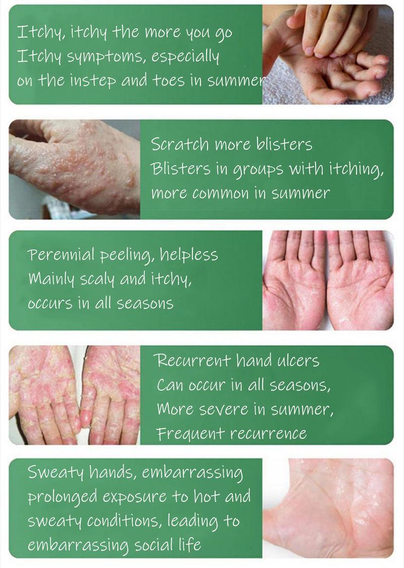 【Buy 1 Get 1 Free】Umex All-Natural Plant-Based Herbal Relief Cream–Soothe & Relieve Itching, Eczema & Sensitive Skin | Family-Safe Botanical Care Moisturizing Soothing Balm