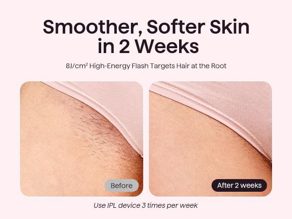 Wavytalk BARE IT Next-Gen Hair Removal with Ice Cooling, 3 Modes & 24J Dual-Pulse for Salon-Level Results on Face, Body & Bikini, Painless & Precise