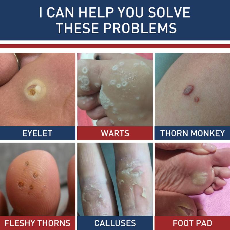 Corn Remover Pads for Feet & Toes - Medicated Patches with 40% Salicylic Acid, Extra Strength Callus Treatment for Small Corns & Calluses, All-Day Adhesive Protection for Active Adults, 24 Count