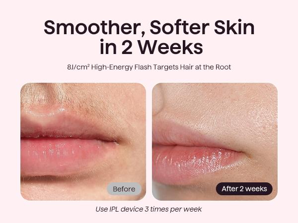 Wavytalk Bare It IPL Hair Removal with Ice Cooling, 3 Modes & 24J Dual-Pulse for Salon-Level Results on Face, Body & Bikini, Painless & Precise