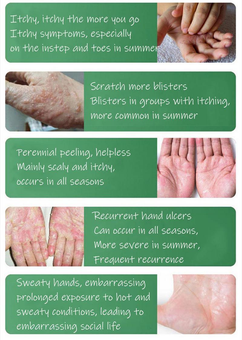 Umex Soothing & Relief Cream with Honeysuckle & Peppermint - 30g, 100% Natural Plant Extracts, Gentle for All Ages, Fast Acting Relieve itching , Hydrates Dry & Sensitive Skin, Therapeutic Treatment for Flare-up,Eczema & Psoriasis Umex Soothing & Relief Cream with Honeysuckle & Peppermint - 30g, 100% Natural Plant Extracts, Gentle for All Ages, Fast Acting Relieve itching , Hydrates Dry & Sensitive Skin, Therapeutic Treatment for Flare-up,Eczema & Psoriasis