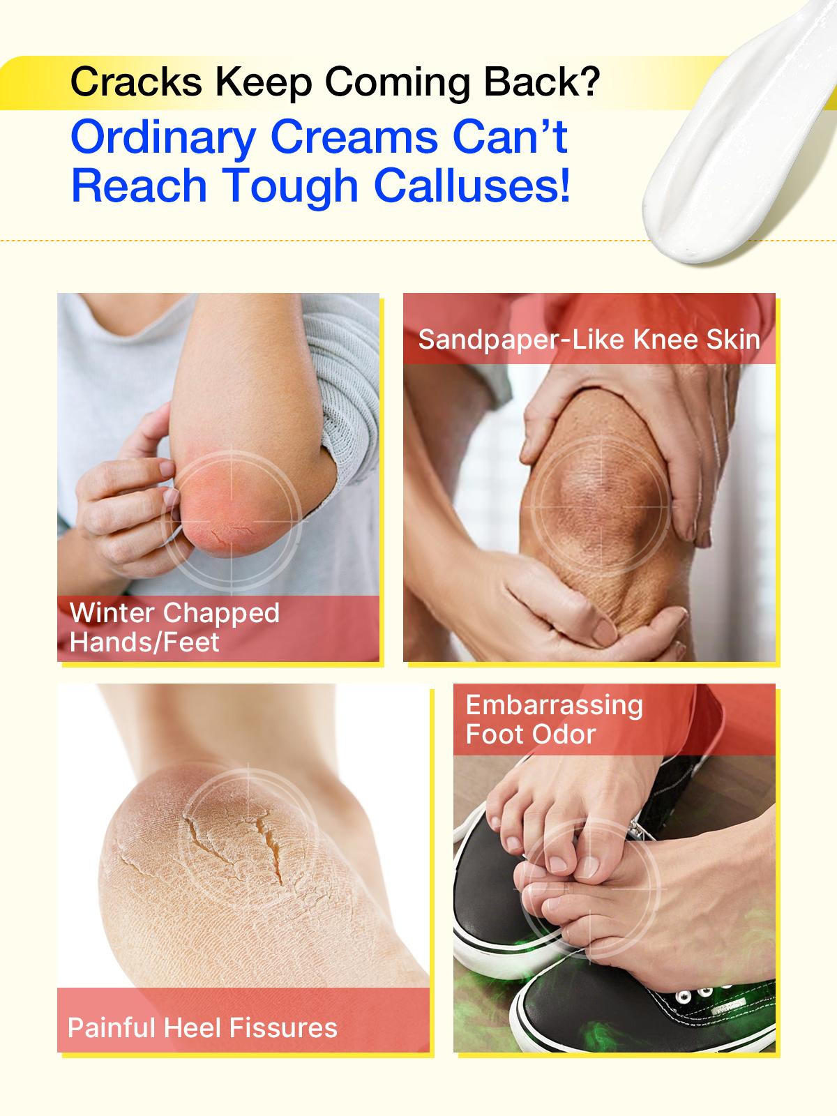 FOOT RESCUE - Advanced Restorative Treatment - Urea Foot Repair Cream - Salicylic Acid Foot Ointment