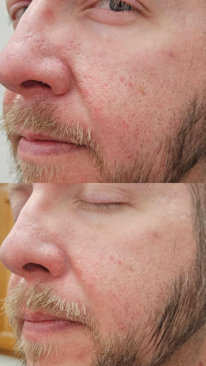 Item: Peel Shot Duo Set(white rice+ black rice)