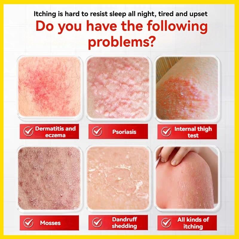 Maximum Strength Anti-Fungal Cream – Targets Psoriasis, Ringworm, Athlete’s Foot, Tinea, Eczema – 100% Plant-Based & Steroid-Free – Soothes Itch, Repairs Dry Skin, Prevents Flare-Ups