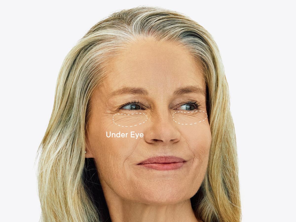 Qure Micro-Infusion Anti Wrinkle Patches for Smile Line, Frown lines, Under Eye Bags, Puffiness, Crow's Feet - Retinol, Niacinamide, Caffeine, Peptides - Dissolvable for Overnight Use - 8 Pairs