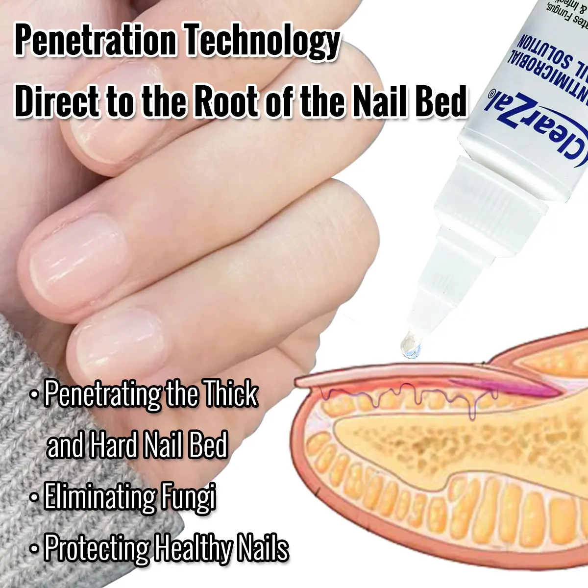ClearZal Antimicrobial BAC Nail Solution Fungal Nail Treatment 1 Ounce Kills Fungus, Bacteria and  Viruses