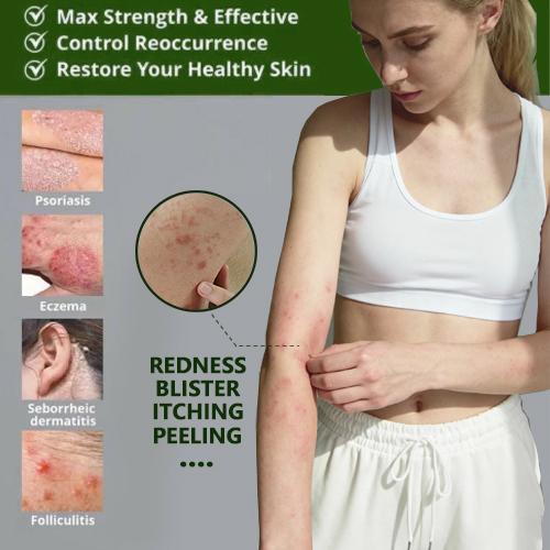 Soothing & Relief Cream for Eczema with 100% Natural Plant Extracts, Relief from Eczema & Blisters, Honeysuckle & Peppermint, Gift for Family and Friends, Gentle for All Ages, Quick-Relief Itch Soother, Moisturizes Dry & Sensitive Skin