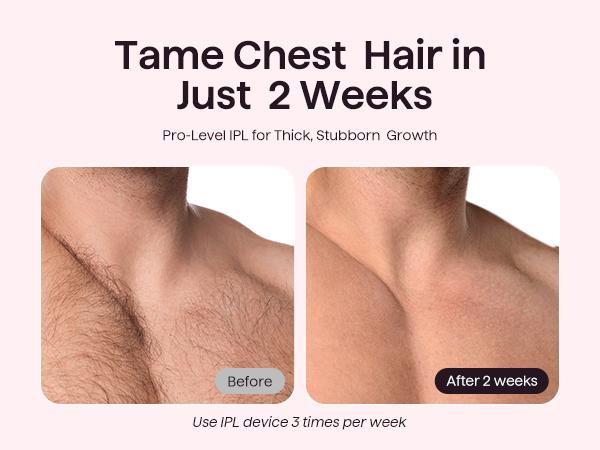 Wavytalk BARE IT Next-Gen Hair Removal with Ice Cooling, 3 Modes & 24J Dual-Pulse for Salon-Level Results on Face, Body & Bikini, Painless & Precise