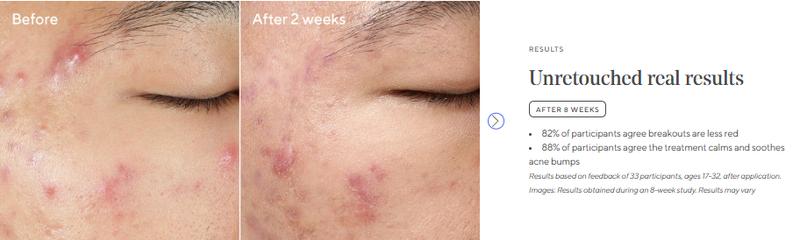 Murad Deep Relief Acne Treatment with 2% Salicylic Acid & Phytosteroid Technology for Severe Acne Healing & Skin Repair