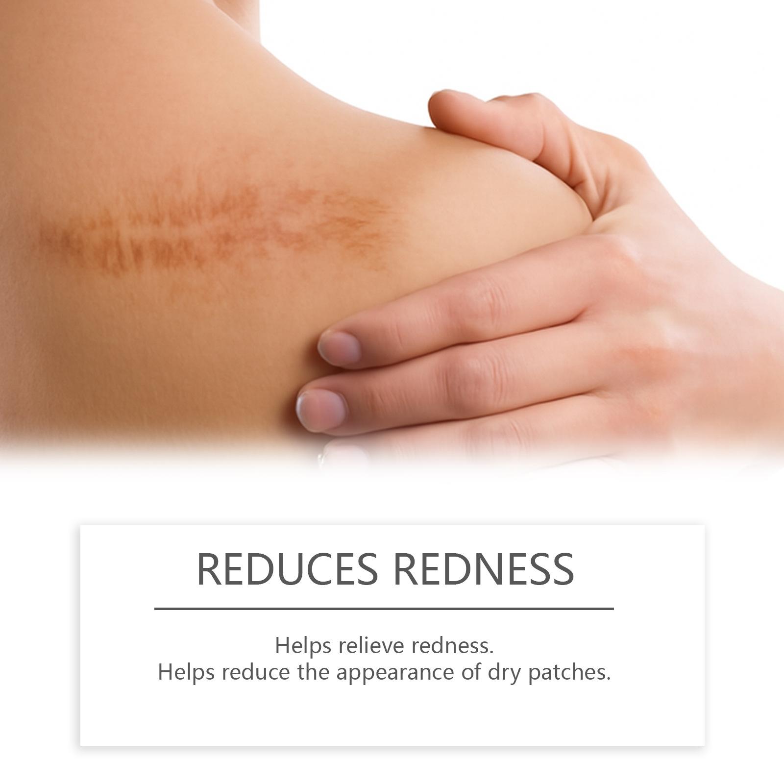 Scar Solutions Silicone Scar Stick for Face and Body 60% Soothing Moisturizing Gentle on All Skin Types Easy-to-Use Stick Design 6g