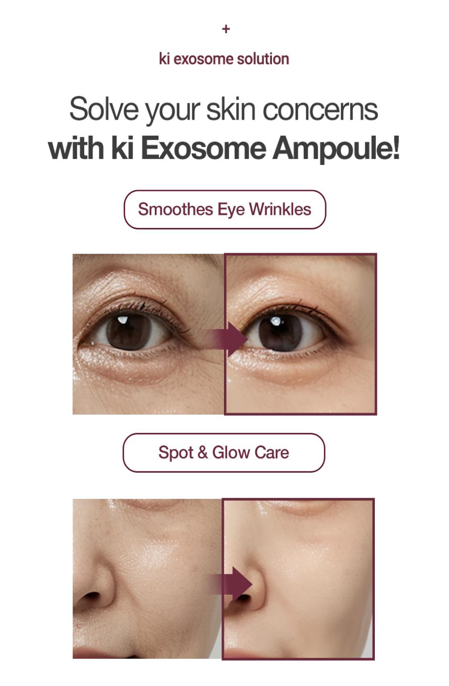 KI Stem-Cell Exosome Booster Kit + 5 Akatsuki White tomato Masks - Anti-Aging & Brightening Ampoule Set with Exosome Solution & Syringe for Radiant Skin Skincare Set Serum Essence