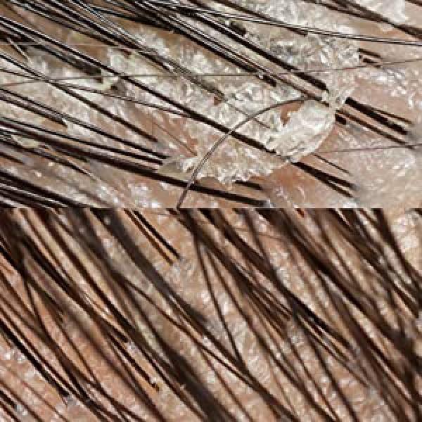 Scalp Massager, Shampoo Brush Hair Scrub Brush for Wet and Dry Hair, Soft Silicone Bristles Head Massager Clean Hair, Reduce Dandruff, Massage Scalp, Promote Hair Growth