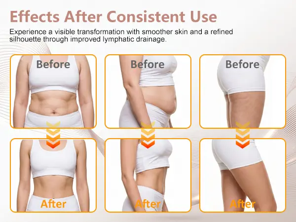 Lymphatic Drainage Massager & Anti-Cellulite Massage Tool, Body Sculpting Device for Arms, Legs & Stomach, Supports Smoother Skin, with Gentle Warming & Vibration, White Lymphatic Drainage Massager & Anti-Cellulite Massage Tool, Body Sculpting Device for Arms, Legs & Stomach, Supports Smoother Skin, with Gentle Warming & Vibration, White