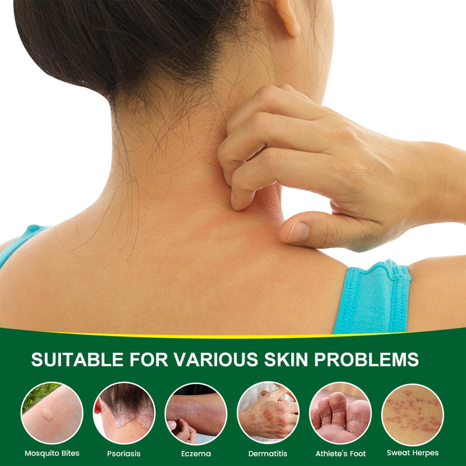 SanNuo Psoriasis & Eczema Cream - Natural Herbal Ointment for Itch Relief, Dry Skin & Sensitive Skin - Soothing & Hydrating Treatment - 30g body glaze Therapeutic Healthy SanNuo Psoriasis & Eczema Cream - Natural Herbal Ointment for Itch Relief, Dry Skin & Sensitive Skin - Soothing & Hydrating Treatment - 30g body glaze Therapeutic Healthy