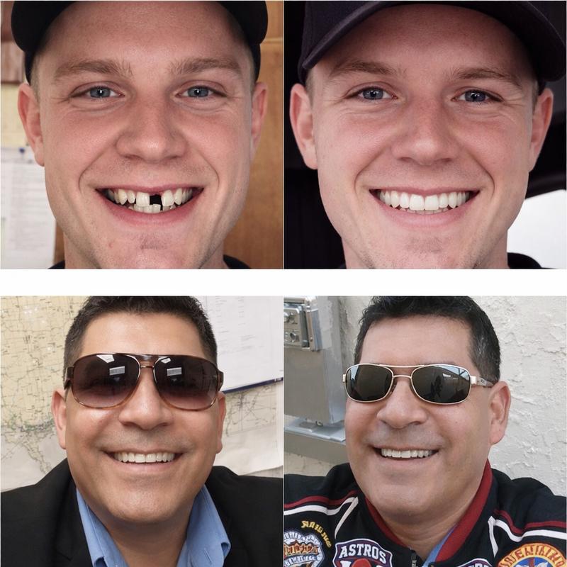 【3 PAIRS】Universal Porcelain-Look Smile Mask  2026 Family Value Set - Reusable Snap-On Fake Teeth for Men & Women (Upper)