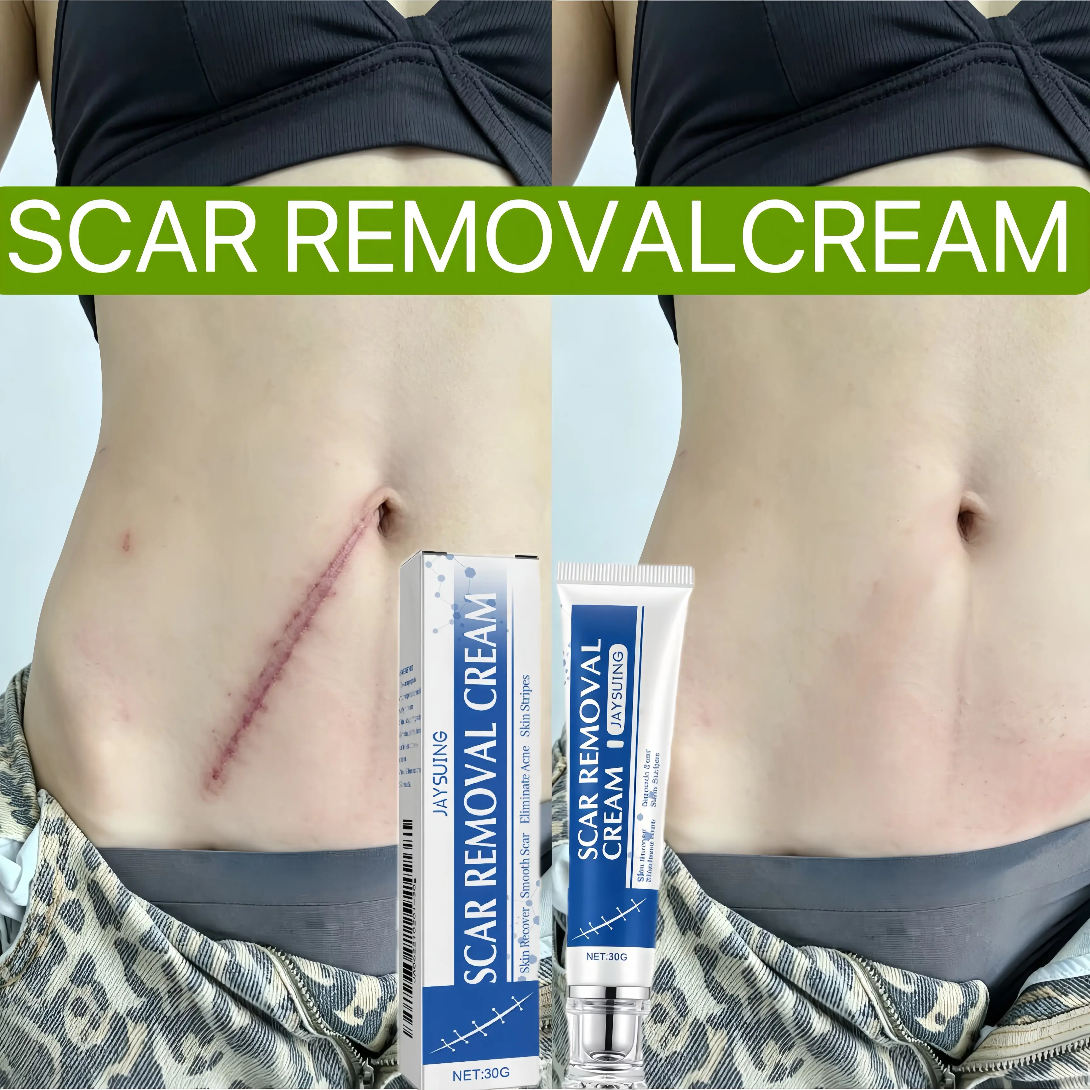 Professional Scar Removal Gel- Scarremovaltreatment for keloids, C-sectionS, surgeries,burns, acne andmore.