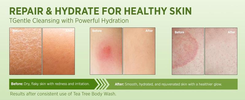 Roycederm Antifungal Body Wash & Soap, Antibacterial, Tinea Versicolor, Tea Tree Body Wash, Back Acne, Folliculitis, For Jock Itch, Athletes Foot, Body Odor, Ringworm Roycederm Antifungal Body Wash & Soap, Antibacterial, Tinea Versicolor, Tea Tree Body Wash, Back Acne, Folliculitis, For Jock Itch, Athletes Foot, Body Odor, Ringworm