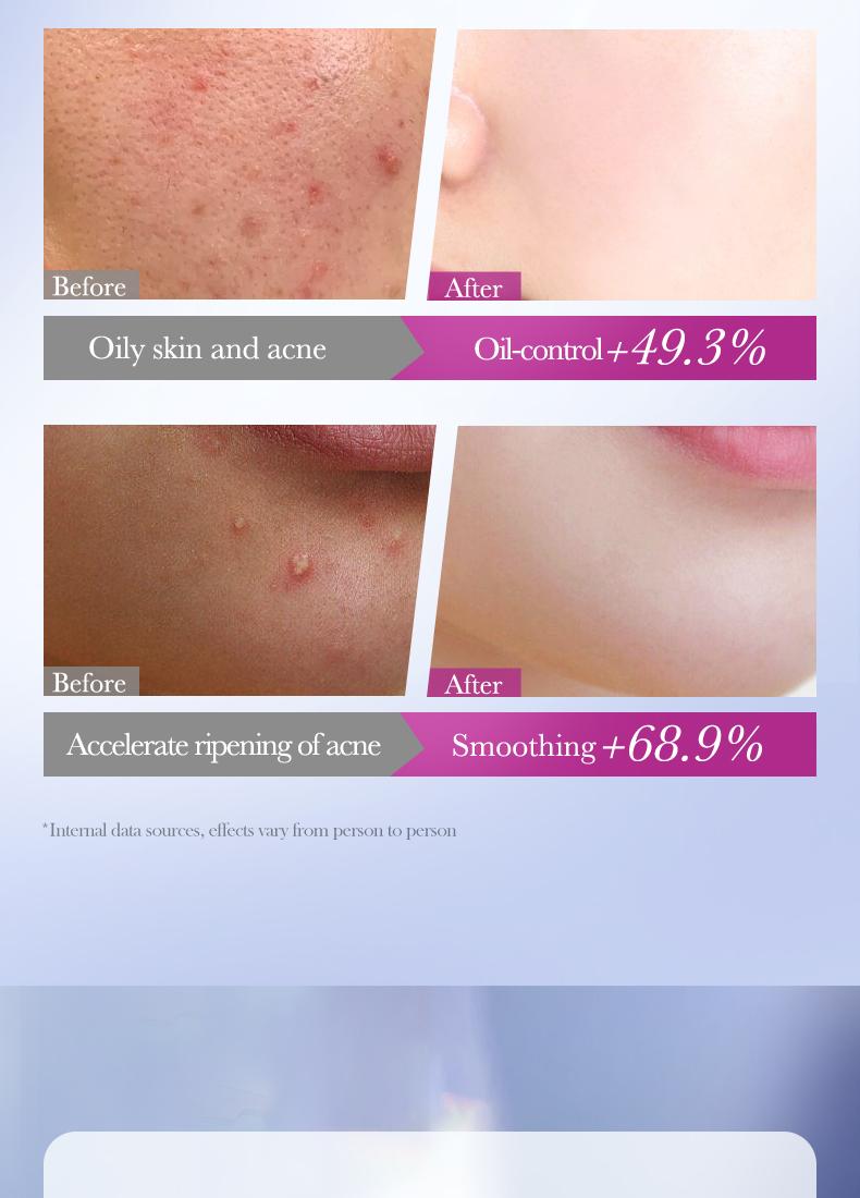 【156PCS】Star Shaped Hydrocolloid Acne Patch,Suitable for All Skin Types,Waterproof Acne Cover Patches, Repair and cover acne blemishes,Blemish Patches,Alcohol-Free Sensitive