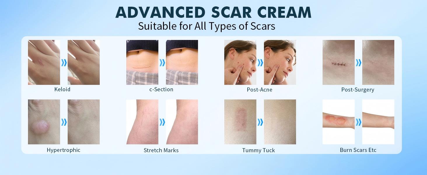 Rvlaim Advanced Silicone Scar Gel, Professional Scar Removal Cream for Surgical Scars, Stretch Mark, Keloid Bump, C-Section, Old and New Scars 1.7 oz(50g)