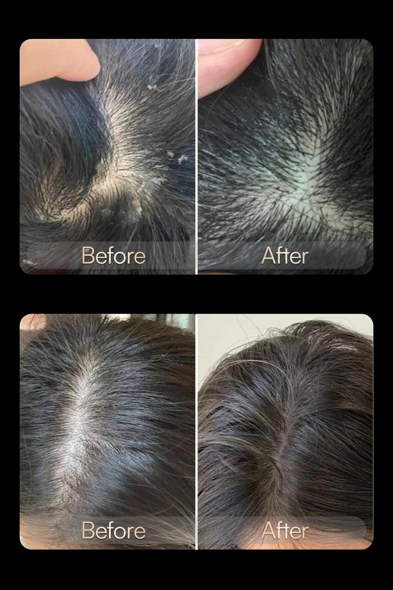 INIA VIBRA 4-in-1 Scalp Therapy Device, Red Light, Microcurrent, Massage, Serum Infusion, Scalp Massager Beauty Device, Waterproof & Wet/Dry Use, Perfect Holiday Gift