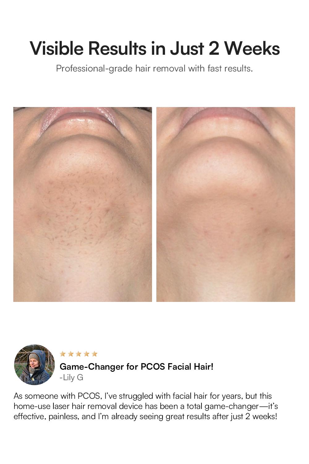 INIA HAUTE Pro Sapphire Ice-Cooling IPL Hair Removal Device – Painless, FDA Cleared, Full Body & Bikini Use, Long-Lasting Results for Women & Men, 2-Year Warranty – Stay Cool & Smooth, Best Valentine's Day Gift for Her