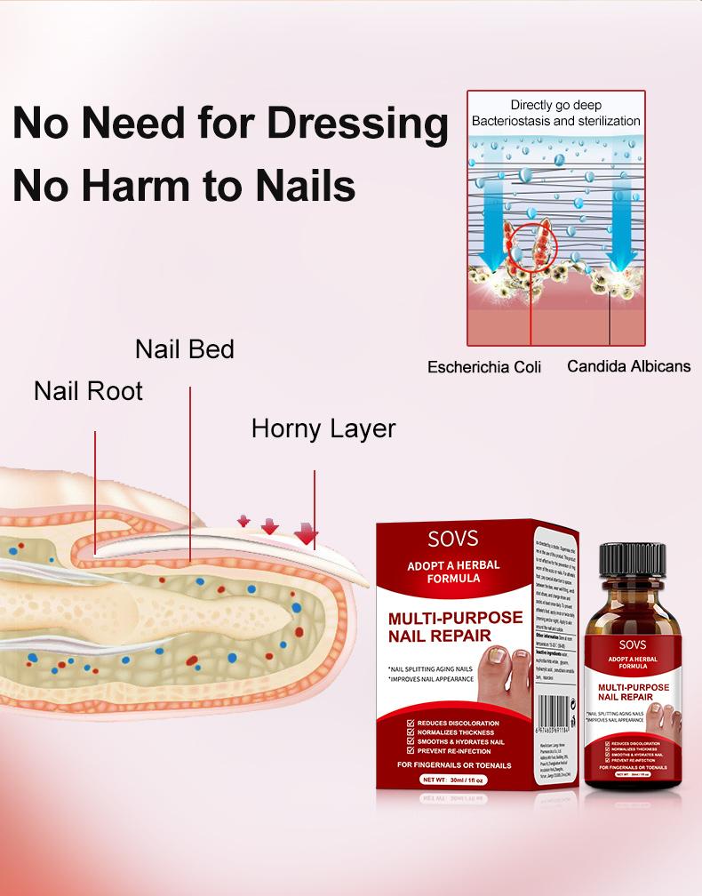 SOVS Toenail Fungus Treatment Extra Strength ,Antifungal Solution ,Triple Action Formula for Damaged Nails, Multi-Purpose Nail Repair,1 Fl Oz Manicure Therapy