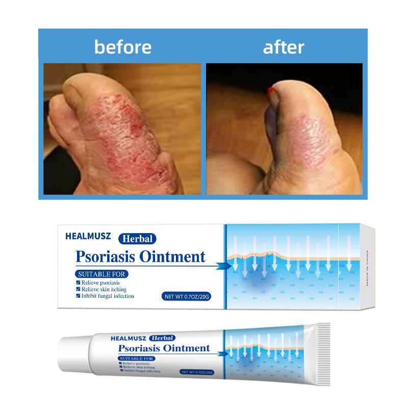 Powerful Antifungal Cream—Results in 7 Days—Effective for Psoriasis, Eczema, Ringworm, Jock Itch, Athlete's Foot, Onychomycosis, and Herpes—100% Natural Botanical Formula—Rapid Itch Relief, Prevents Recurrence, Repairs Dry, Cracked Skin Body Care Cream