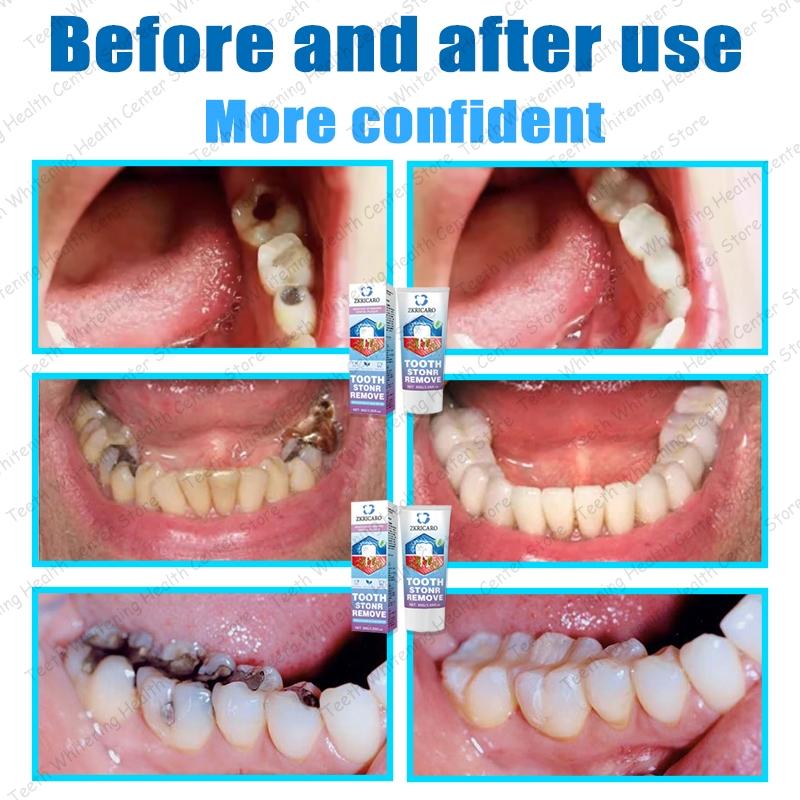 ZKRICARO Anti-Cavity Repair Toothpaste FDA Certified Cavity Repair Whitens Teeth Strengthens Enamel Relieves Sensitivity & Bad Breath