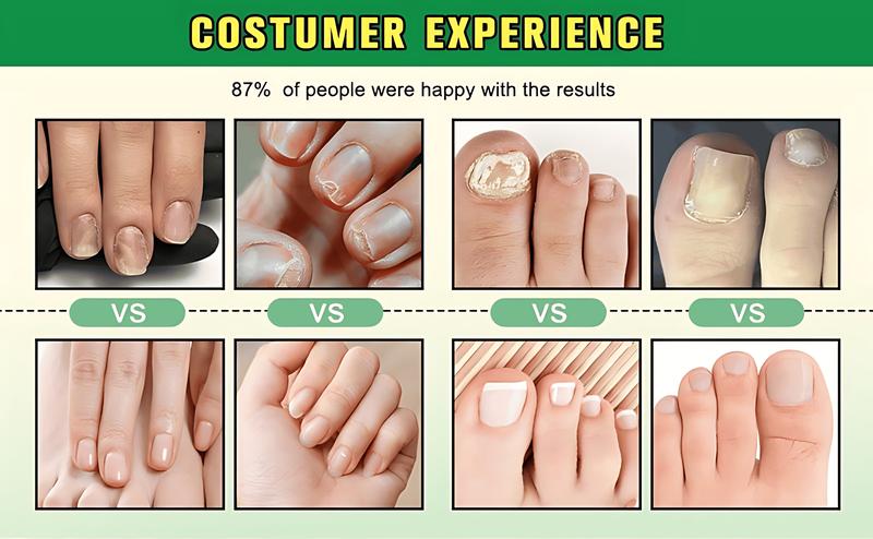 7-Day Nail Fungal Treatment Serum Foot Fungus Remedy Removal Products Anti infection Onychomycosis Paronychia Repair Gel Care Ginger Healthcare Therapeutic Therapy Bathroom Solution nailgrowthoil Healthy Wellness Aid Liquid Fitness Organic Skin Ginkgo 7-Day Nail Fungal Treatment Serum Foot Fungus Remedy Removal Products Anti infection Onychomycosis Paronychia Repair Gel Care Ginger Healthcare Therapeutic Therapy Bathroom Solution nailgrowthoil Healthy Wellness Aid Liquid Fitness Organic Skin Ginkgo