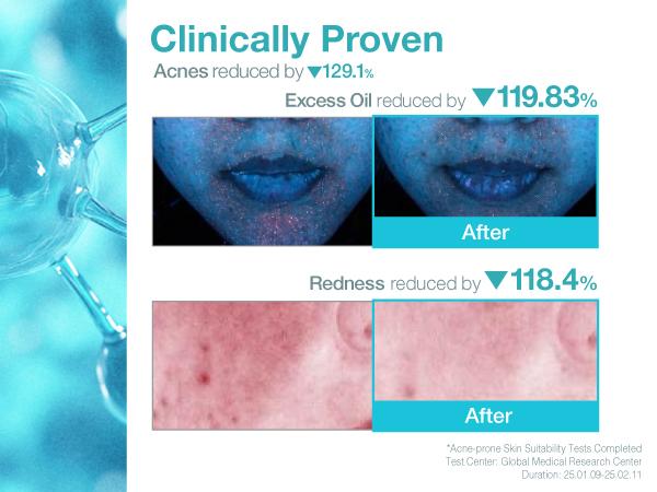 [numbuzin official shop] No.1 Sheet Mask | Pantothenic B5 Hyaluronic Active Clear Mask | Calming, Soothing, Hydrating | Acne Prone Skin | Controls Excess Oil, Reduces Redness, Safe for Sensitive Skin | 4 Sheets