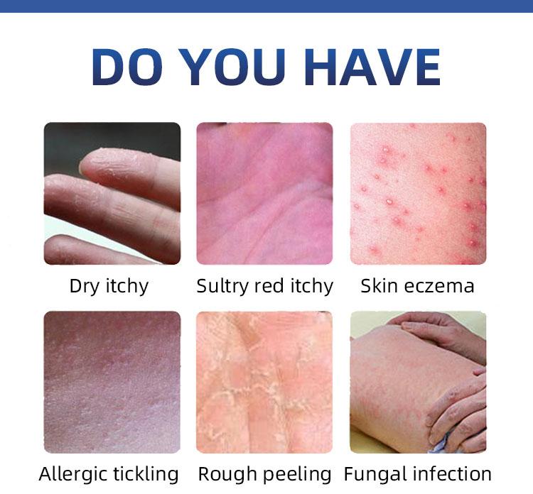 Maximum Strength Anti-Fungal Cream – Targets Psoriasis, Ringworm, Athlete’s Foot, Tinea, Eczema – 100% Plant-Based & Steroid-Free – Soothes Itch, Repairs Dry Skin, Prevents Flare-Ups Maximum Strength Anti-Fungal Cream – Targets Psoriasis, Ringworm, Athlete’s Foot, Tinea, Eczema – 100% Plant-Based & Steroid-Free – Soothes Itch, Repairs Dry Skin, Prevents Flare-Ups