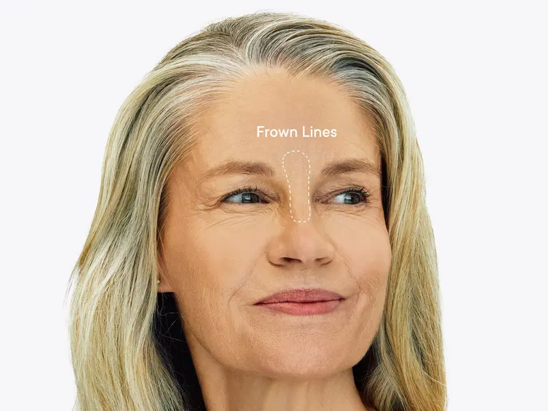 Product Introduction of Qure Micro-Infusion Anti Wrinkle Patches for Smile Line, Frown lines, Under Eye Bags, Puffiness, Crow's Feet - Retinol, Niacinamide, Caffeine, Peptides - Dissolvable for Overnight Use - 8 Pairs 9