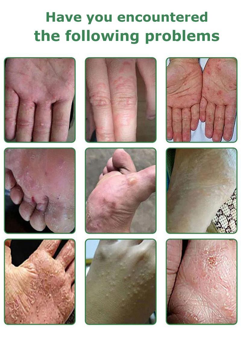 Umex All-Natural Plant-Based Herbal Relief Cream – Soothes Eczema, Psoriasis, Dry & Sensitive Skin | Ancient Botanical Formula for Whole Family Moisturizing Daily