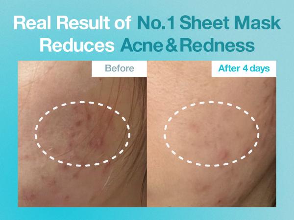 [numbuzin official shop] No.1 Sheet Mask | Pantothenic B5 Hyaluronic Active Clear Mask | Calming, Soothing, Hydrating | Acne Prone Skin | Controls Excess Oil, Reduces Redness, Safe for Sensitive Skin | 4 Sheets