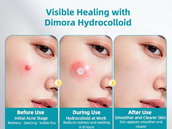 Dimora Medical-Grade Hydrocolloid Acne Patch, Acne spot treatment, Cuttable Overnight Pimple Patch, Acne Mark Fading Patch, Large Size Roll (2 in × 16 ft), Suitable for Acne, Open Wounds, and Sensitive Skin