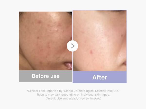 [LIVE Exclusive] [medicube] Pocket-friendly At Home Facial SETㅣK-beauty Affordable Viral Device in a Petite Size for After Spot & Soothing & Glow Care