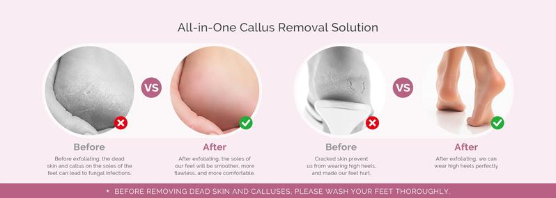 PC800G Rechargeable Feet Callus Remover, ginger nail treatment and portable foot care tool