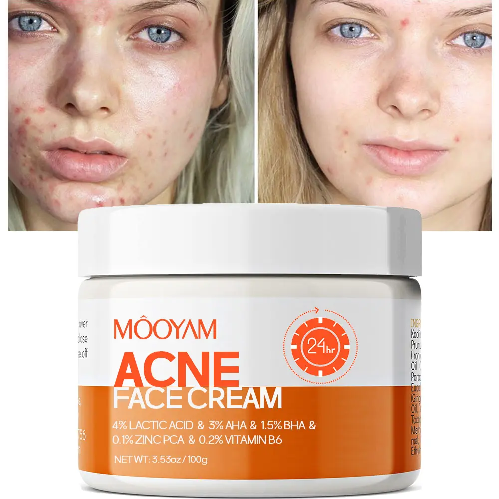 mooyam Cystic Acne Treatment Cream with 3% AHA, Salicylic Acid & Zinc PAC, Calming Skin Care for Post-Acne Marks & Sensitive Skin - 50ml, Bump Clearing Acne Treatments