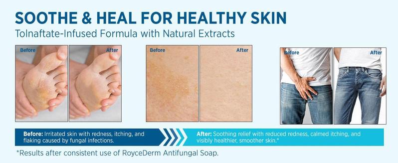 Roycederm Antifungal Tea Tree Oil Soap: Extra Strength Medicated Bar Soap Skin Fungus Treatment for Athletes Foot, Jock Itch & Ringworm - Deep Cleansing