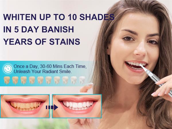 MySmile Flagship Version Whitening Kit with 28x LED Light w/ 35% CP